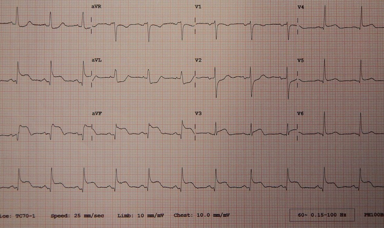 Myocardial Infraction