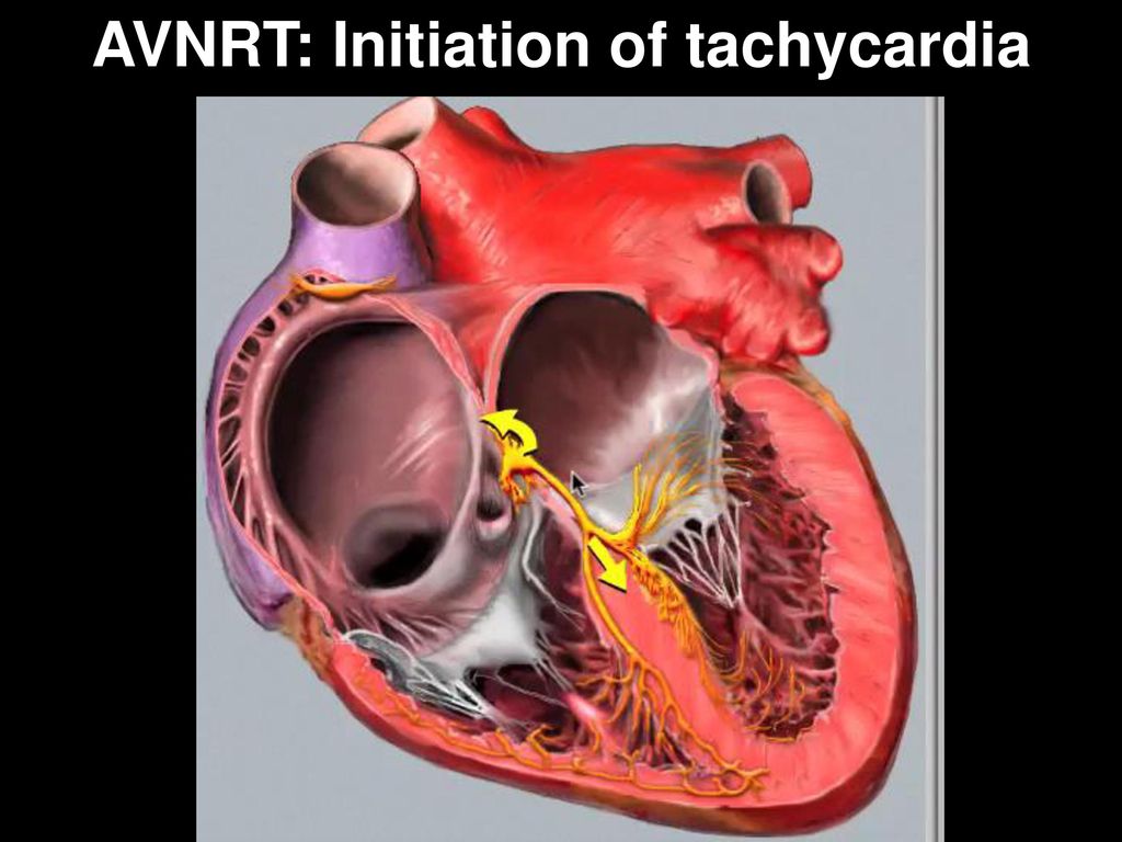 Atrioventricular Nodal Reentrant Tachycardia (AVNRT)