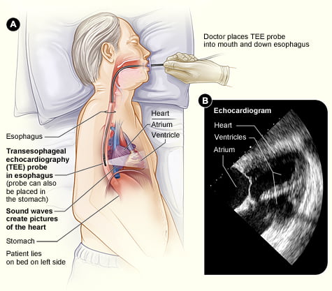 Transesophageal Echocardiogram (TEE)