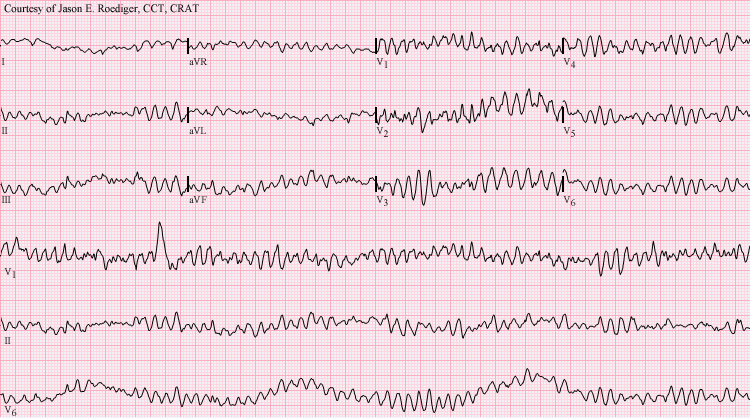 Arrhythmia- Ventricular fibrillation