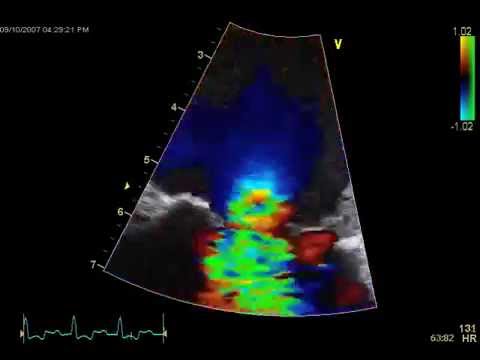 Doppler Echocardiogram: Visualizing the Heart's Blood Flow