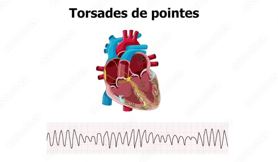 Torsades de Pointes