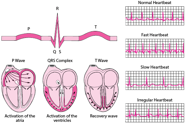 Torsades de Pointes