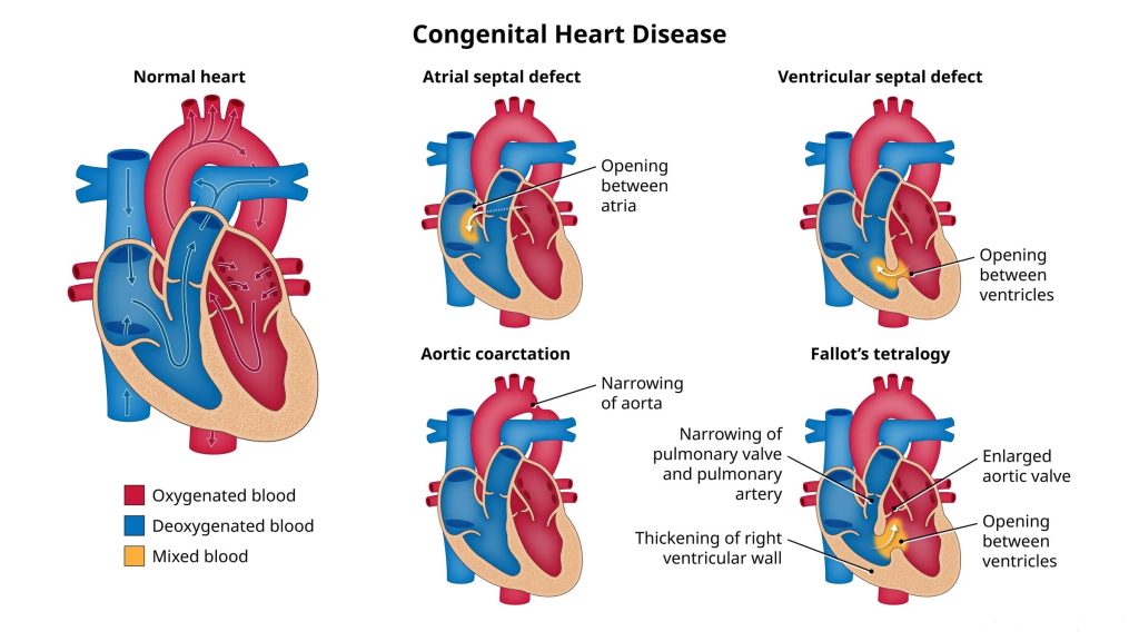 Congenital Heart Defects