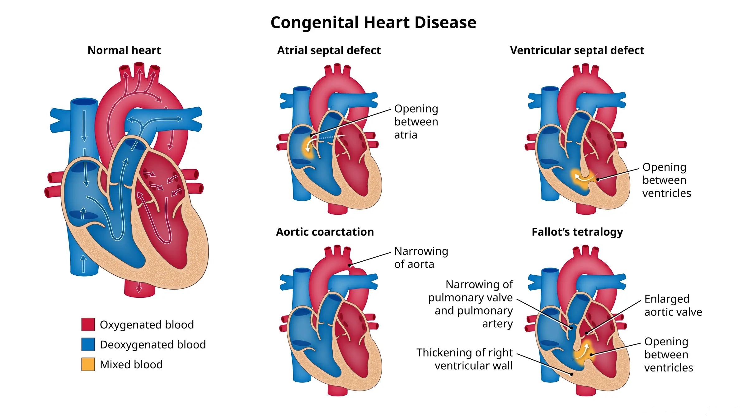 Congenital Heart Defects